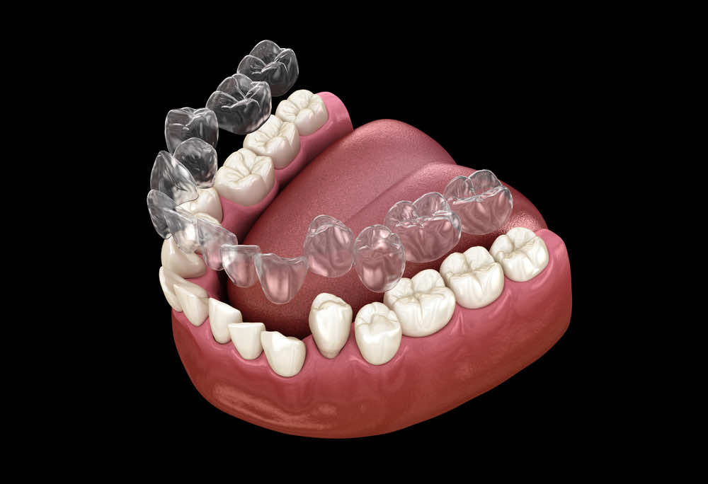 clear-aligner-for-teeth-on-a-dental-set